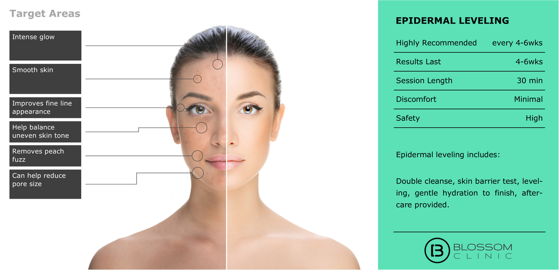 Dermal Filler Injection Treatment Areas